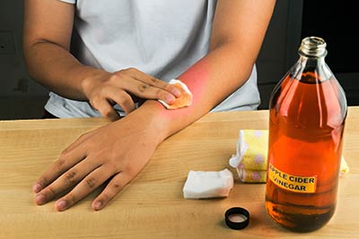 woman treating arm with apple cider vinegar