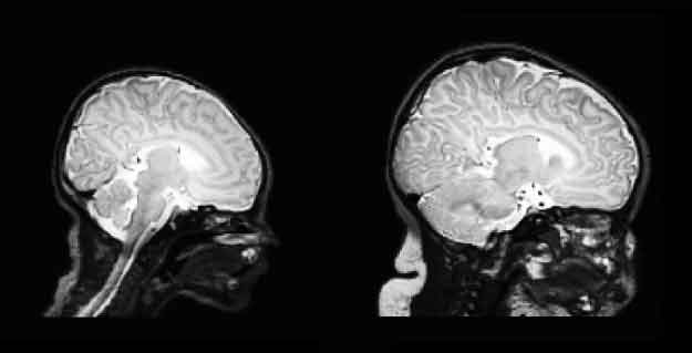 how much a baby brain grows first 90 days