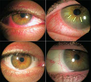 before and after tea tree oil treatment of eyelids