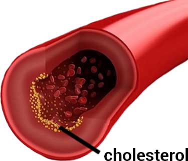 cholesterol in blood vessel diagram