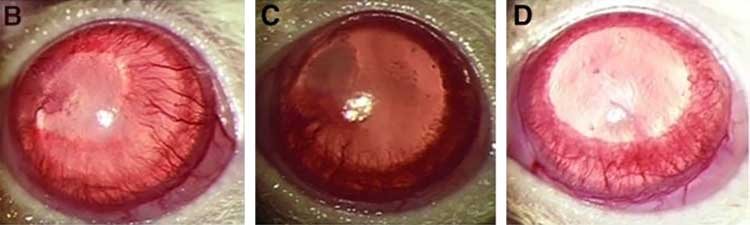 corneal neovascularization with fruit vs. placebo