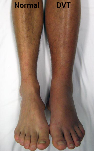 what DVT in leg looks like