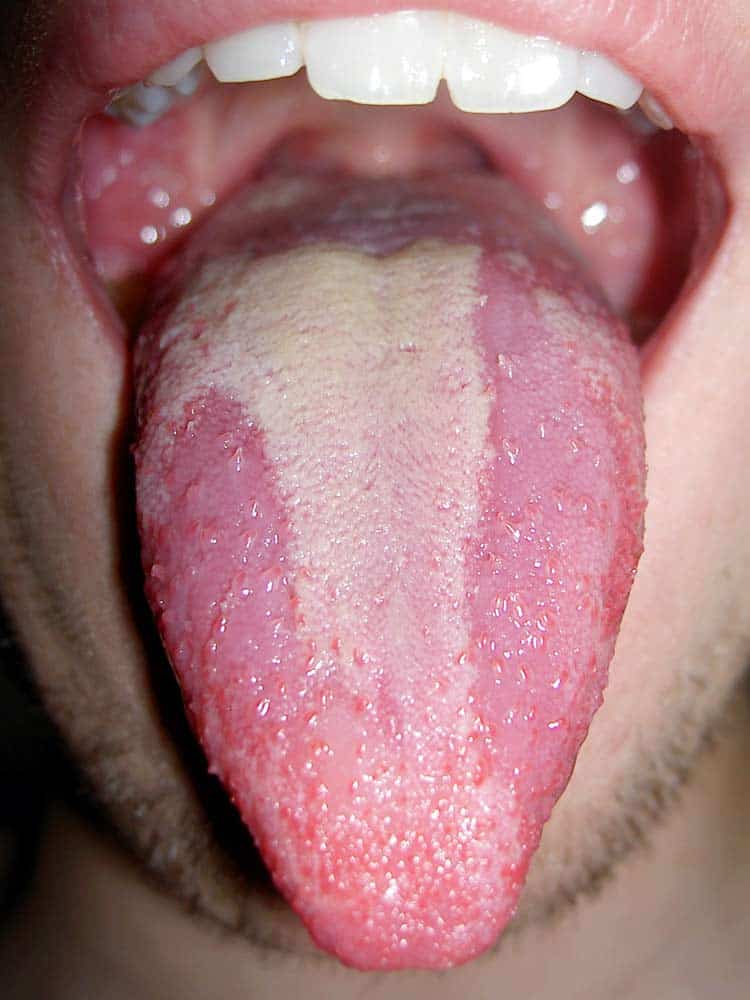 geographic tongue