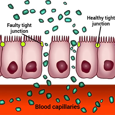 diagram of what leaky gut is