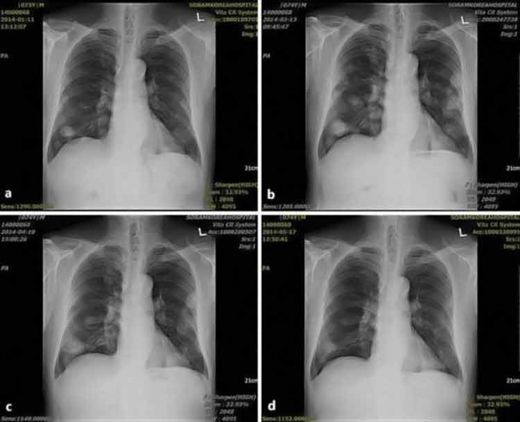 lung cancer X-rays