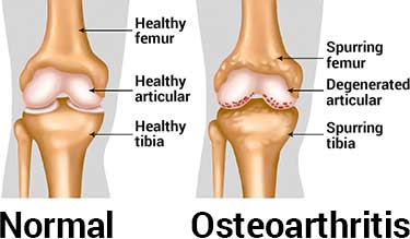 diagram of osteoarthritis in the knee