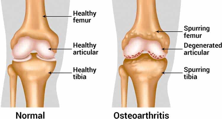 diagram of osteoarthritis in the knee