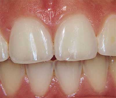 enamel damage from acid vinegar