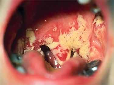 thrush infection photo