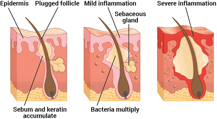 stages of how acne forms