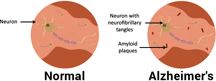 amyloid plaques and neurofibrillary tangles in Alzheimer's disease