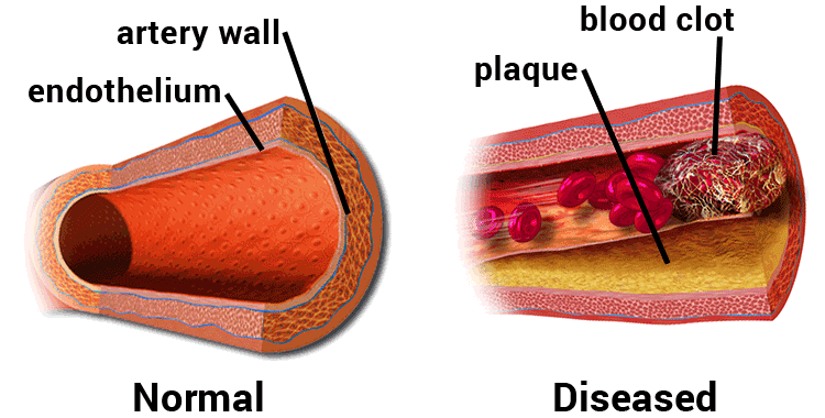 diagram of normal vs. diseased artery, showing plaque and blood clot